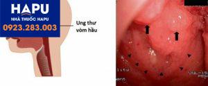 Phát hiện sớm và chẩn đoán bệnh ung thư vòm hầu