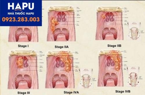 Các giai đoạn ung thư vòm hầu