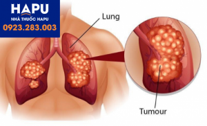 Bệnh ung thư phổi và các dấu hiệu để nhận biết bệnh