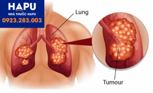 Các phương pháp giúp phát hiện sớm ung thư phổi