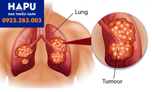 dấu ấn ung thư phổi