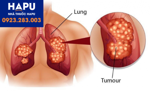 dấu ấn ung thư phổi