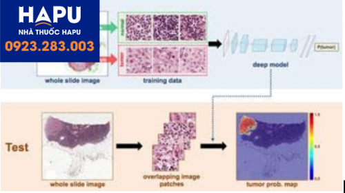 ung-dung-tri-tue-nhan-tao-trong-chan-doan-mo-benh-hoc-benh-ly-ung-thu-tuyen-tuy