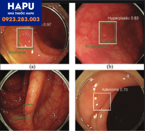 phan-tang-nguy-co-benh-nhan-de-tranh-bo-sot-polyp-dai-truc-trang-va-vai-tro-cua-tri-tue-nhan-tao-1