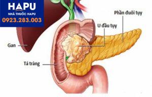 Ung thư tuyến tụy là gì ? Nguyên nhân và triệu chứng