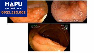 Các khối u nội tiết biểu mô hỗn hợp (MANEC) và tiên lượng bệnh