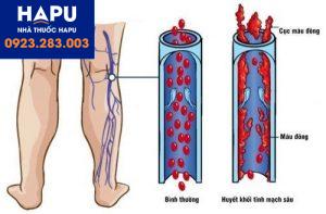 Nguy cơ huyết khối tĩnh mạch ở bệnh nhân ung thư tuyến tụy