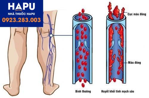 ung thư tuyến tụy