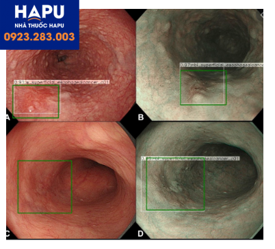 Trí tuệ nhân tạo chẩn đoán ung thư sớm thực quản
