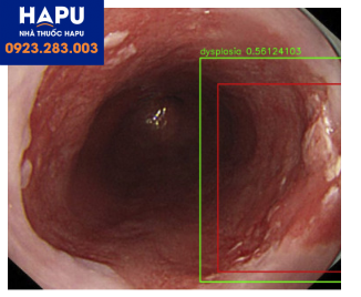 Trí tuệ nhân tạo trong nội soi tự khu trú tổn thương và tính toán tỉ lệ phần trăm tổn thương là ung thư