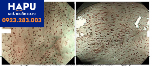 Hình ảnh ung thư sớm thực quản qua nội soi phóng đại