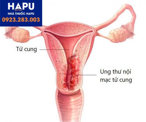 ung thư nội mạc tử cung