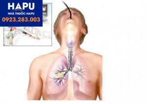 Bệnh ung thư phổi và những điều cần biết về ung thư phổi