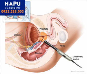 Giải phẫu sinh thiết trong ung thư tuyến tiền liệt là gì ?