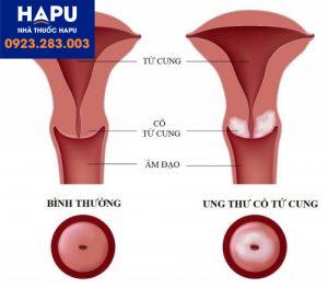 Các xét nghiệm trong ung thư cổ tử cung là những xét nghiệm nào?