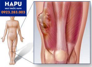 Dấu hiệu cảnh báo bệnh ung thư xương là gì ? Cùng tìm hiểu