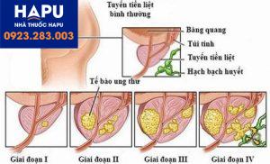 Chẩn đoán bệnh ung thư tiền liệt tuyến như thế nào?