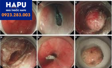 Một khối u dưới niêm được cắt qua kỹ thuật tạo đường hầm dưới niêm mạc