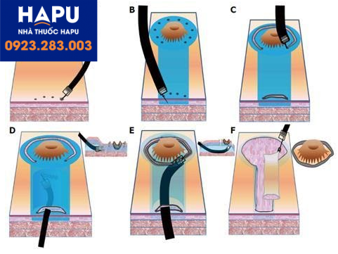 Kỹ thuật cắt qua nội soi đường hầm dưới niêm mạc