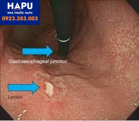Ung thư dạ dày sớm: chẩn đoán bệnh và điều trị nội soi?